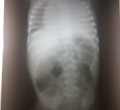 Trasladarán al Hospital Nacional a niña con neumonía