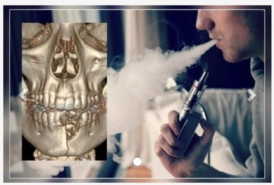Le explotó el "vape" y le rompió la mandíbula