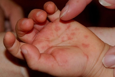 Virus de manos, pies y boca, una enfermedad común en niños pequeños