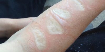 “Salt and ice challenge”, otro peligroso reto viral