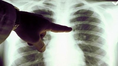 Luz roja para tratar el cáncer de pulmón