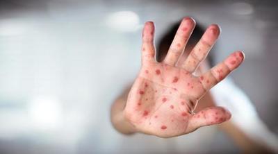 Otra plaga se apresta a entrar al país: sarampión ya mató a 15 en Brasil y la epidemia se expande