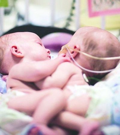 Papás de los bebés siameses aceptaron la operación